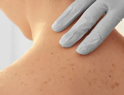Australia has the highest rate of skin cancer