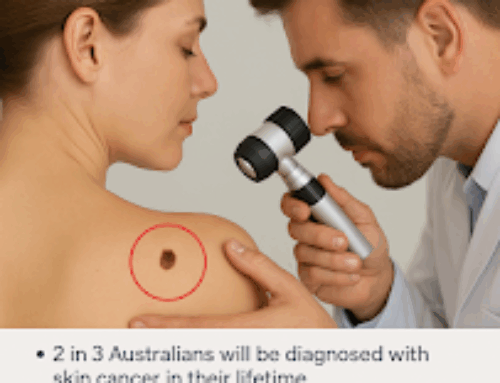 Why get a Skin Check now